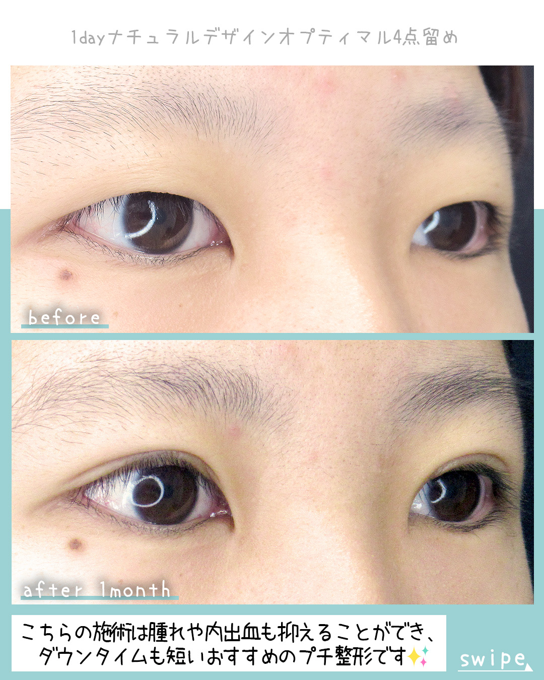 二重埋没法の症例写真 施術前後 