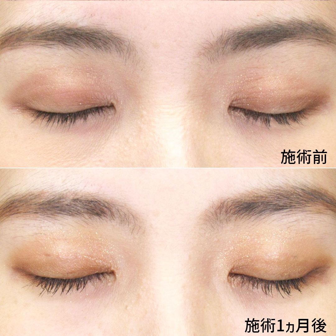 二重埋没法の症例写真 施術前後 