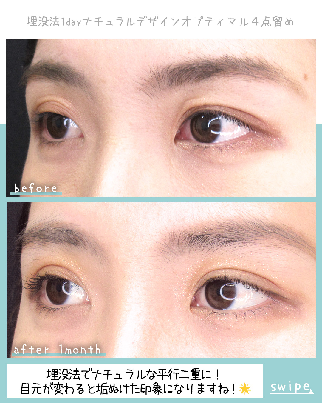 二重埋没法の症例写真 施術前後 