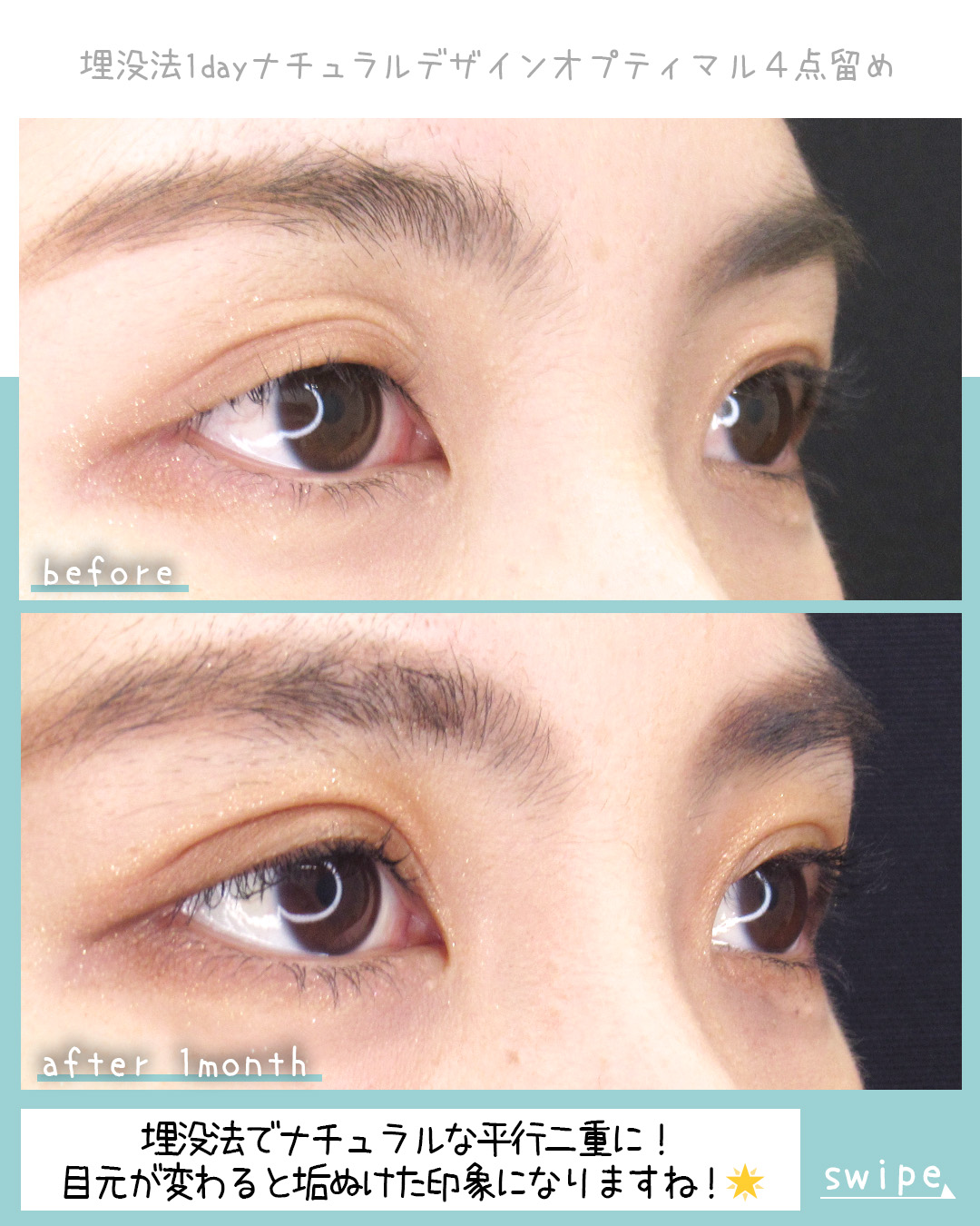 二重埋没法の症例写真 施術前後 