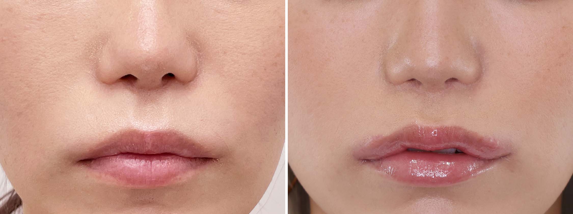 ボトックス注射：その他の症例写真 施術前後 4か月半