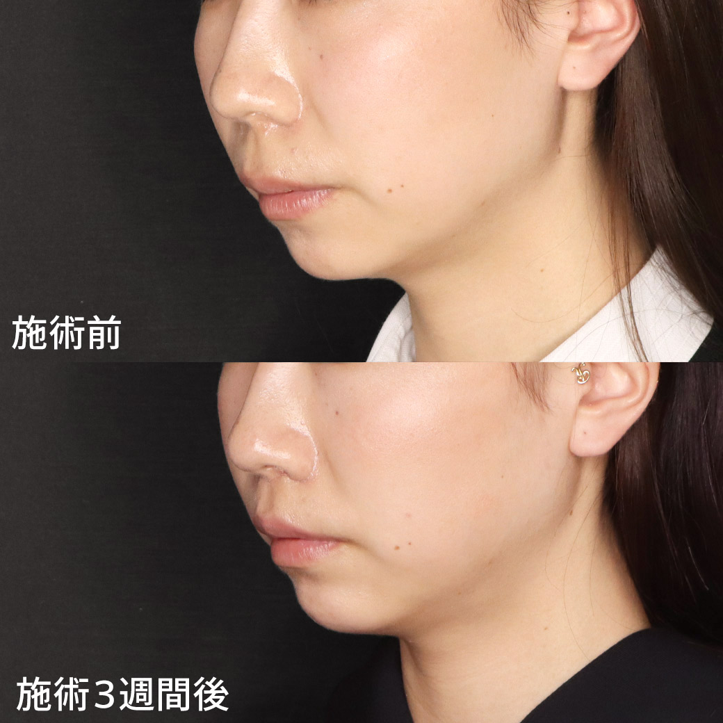 人中短縮術(リップリフト)・外側人中短縮術/顎のヒアルロン酸注射/ソノクイーン（ハイフ）の症例写真 施術前後 