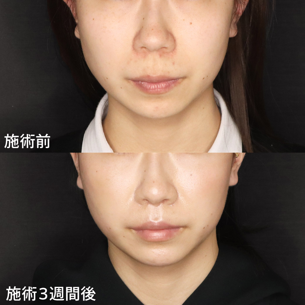 抜糸不要の人中短縮術でダウンタイムも目立ちにくく