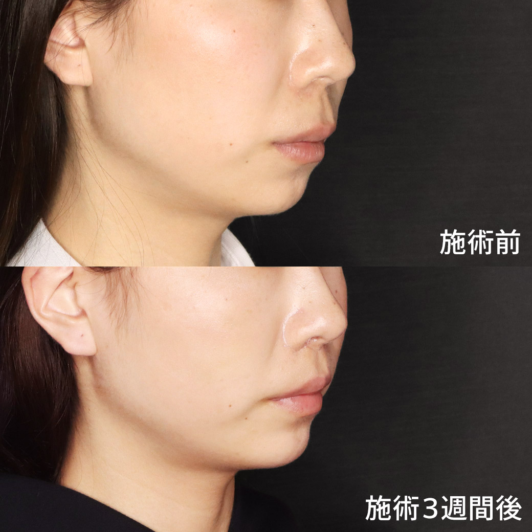 人中短縮術(リップリフト)・外側人中短縮術/顎のヒアルロン酸注射/ソノクイーン（ハイフ）の症例写真 施術前後 