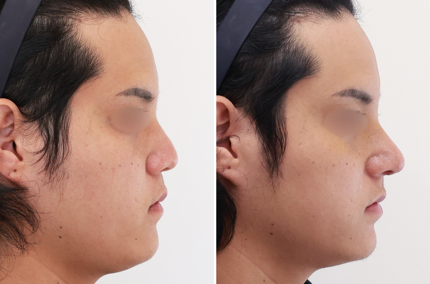 鼻中隔延長・鼻尖部軟骨移植術・鼻プロテーゼ入れ替えでお顔の印象を変える