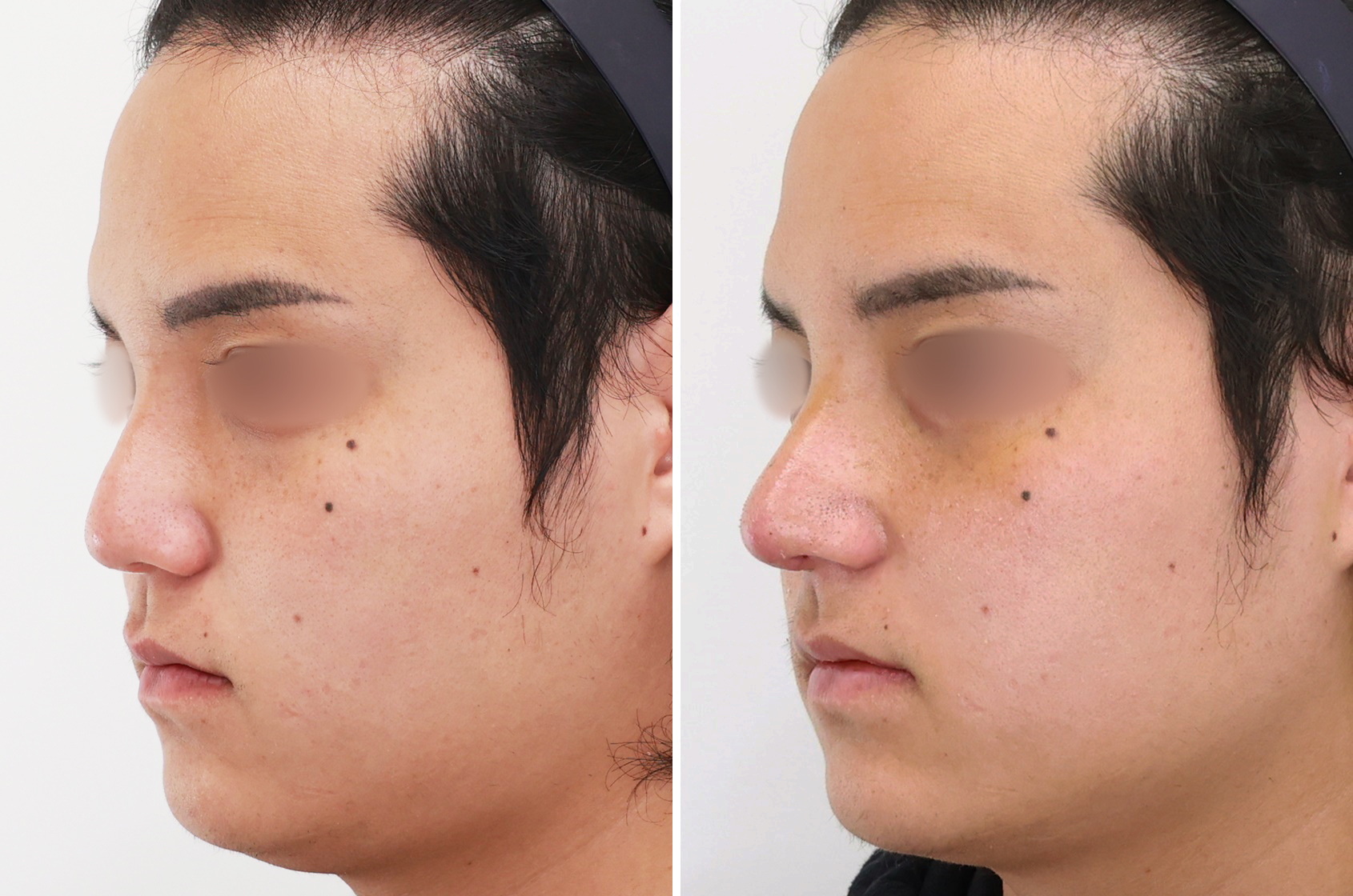 鼻中隔延長術/鼻尖形成・鼻尖縮小/鼻先軟骨移植の症例写真 施術前後 1週間