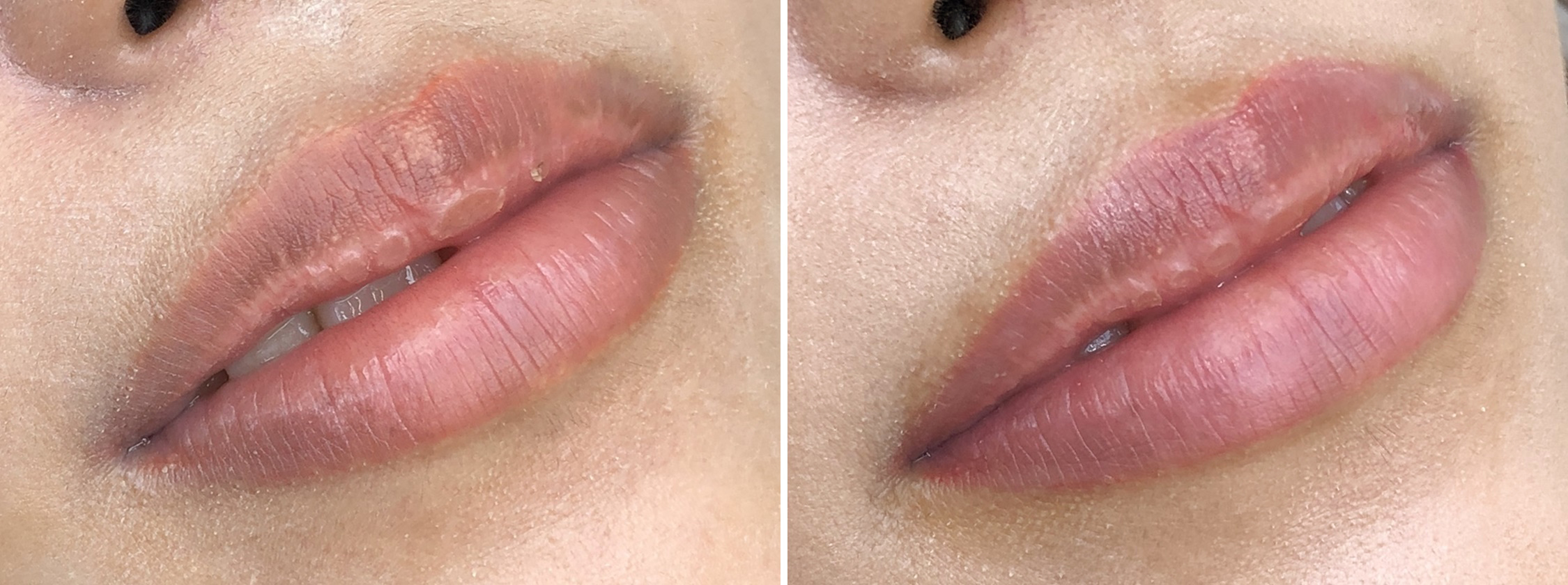 TACメディカルアートメイク（眉・アイライン・リップ）の症例写真 施術前後 2回目施術1ヵ月