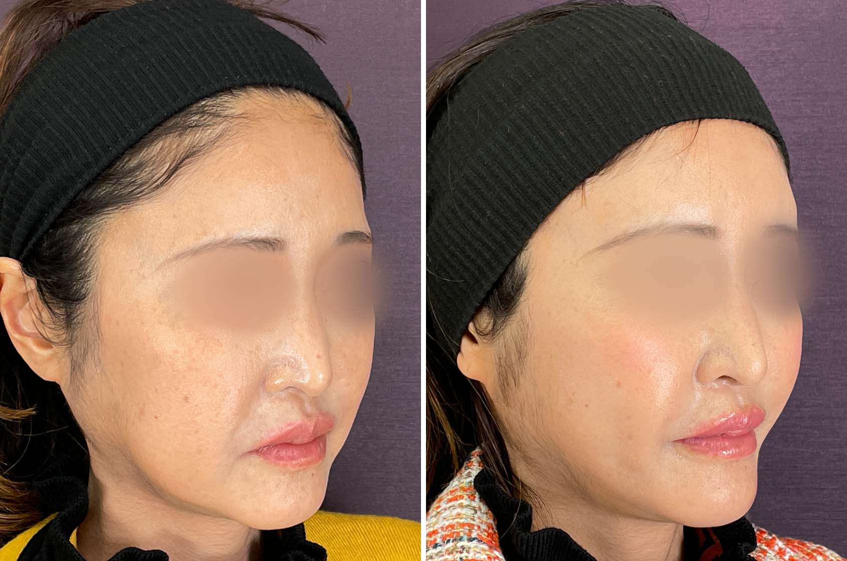 TAC式 ツヤ肌コラーゲンリフト®/ジョールファット除去/おでこ・こめかみのヒアルロン酸注射の症例写真 施術前後 1か月