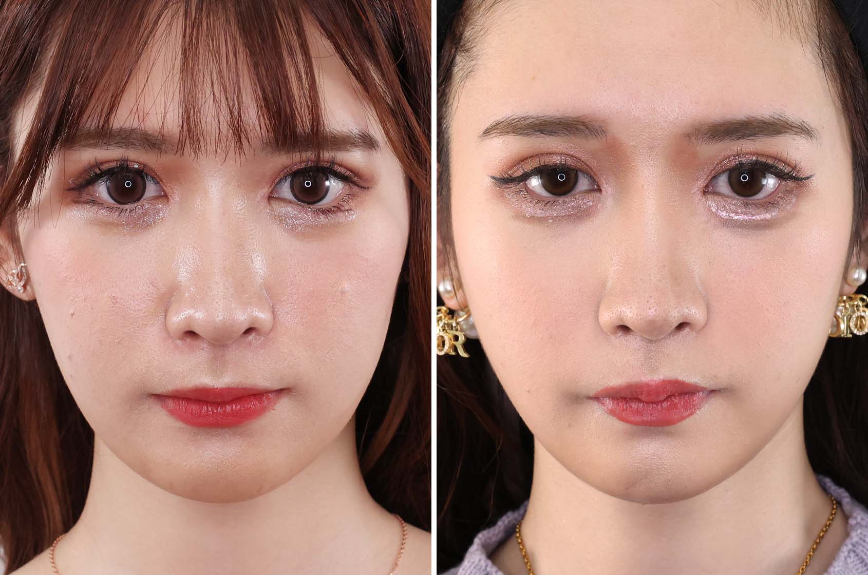 リフトアップでフェイスラインに自信がもてる！さらに美肌効果も！