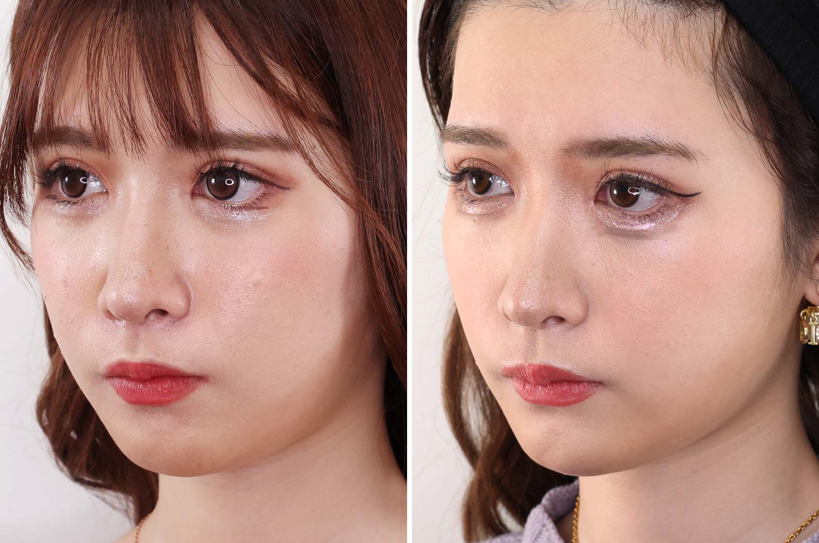 TAC式 ツヤ肌コラーゲンリフト®/ジョールファット除去の症例写真 施術前後 1ヵ月