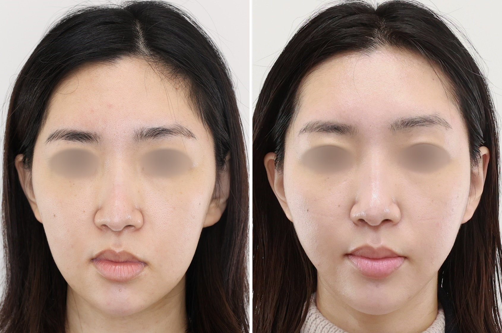 TAC式 ツヤ肌コラーゲンリフト®の症例写真 施術前後 1ヵ月