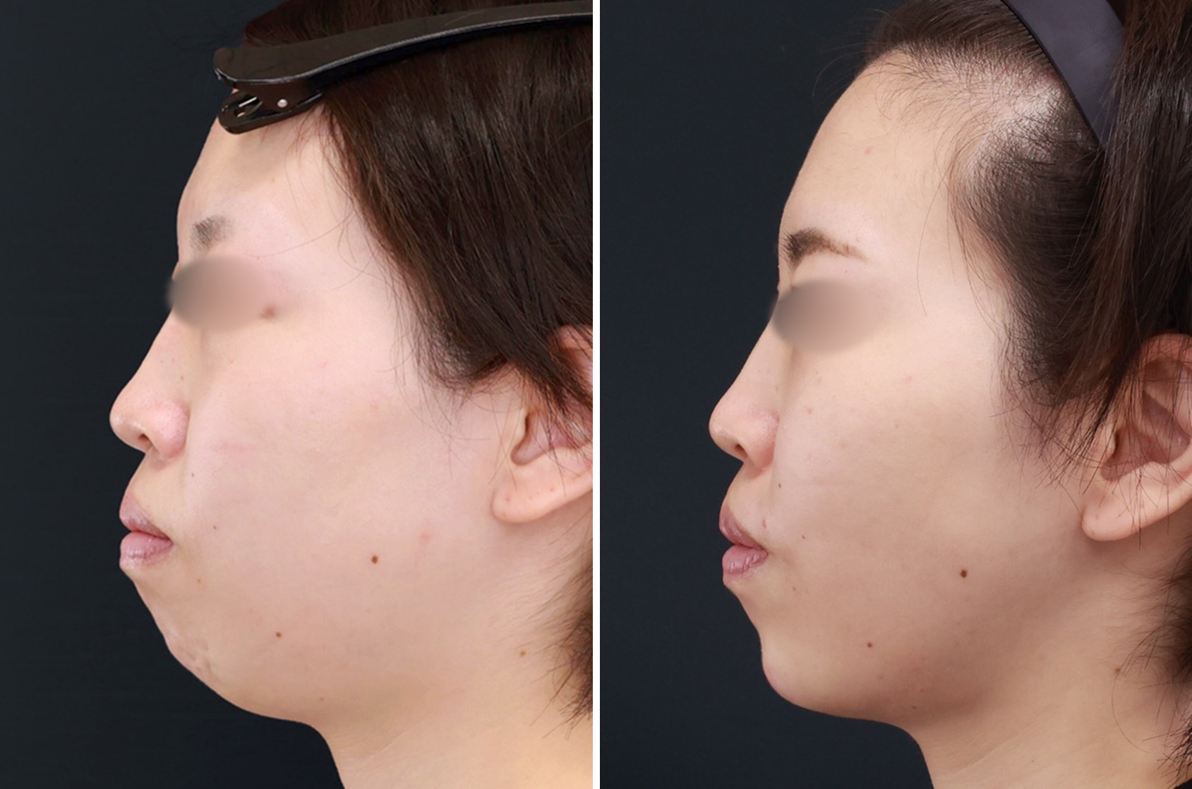 TACツヤ肌コラーゲンリフトとお顔の脂肪吸引で 顎とフェイスラインの形がくっきり