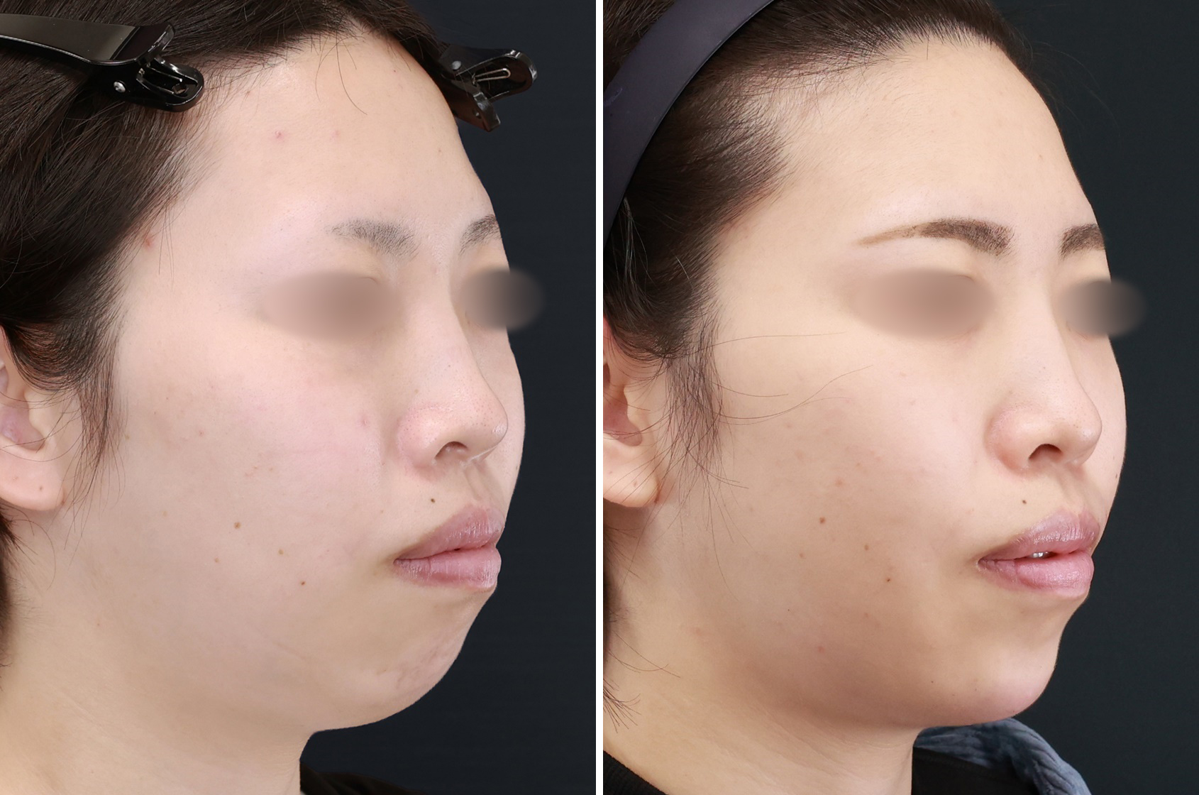 顎下の脂肪吸引/TAC式 ツヤ肌コラーゲンリフト®/ボトックス注射：その他の症例写真 施術前後 1ヵ月