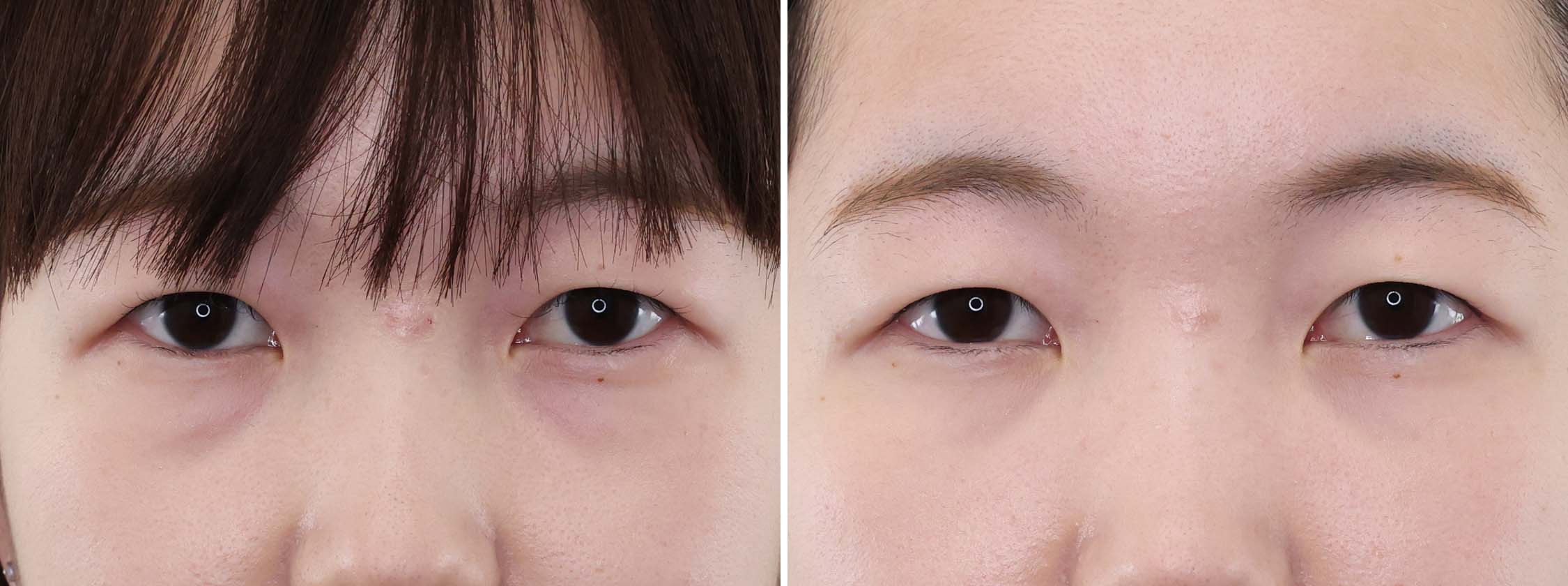 気になる目の下の影に悩まされる日々・・・クマ・ふくらみとりと脂肪注入でスッキリ解消！