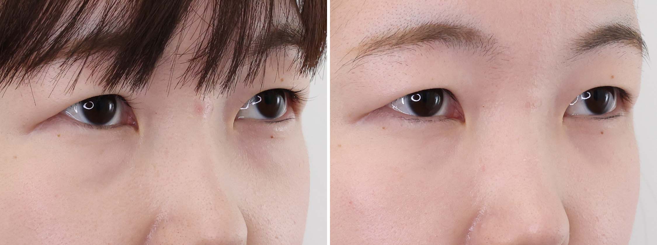 下眼瞼脱脂術（目の下のたるみ取り・目の下の脂肪ふくらみ取り）/顔の脂肪注入(コンデンスリッチフェイス)の症例写真 施術前後 1ヵ月