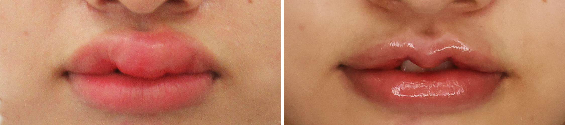 M字リップ形成の他院修正で理想の唇へ