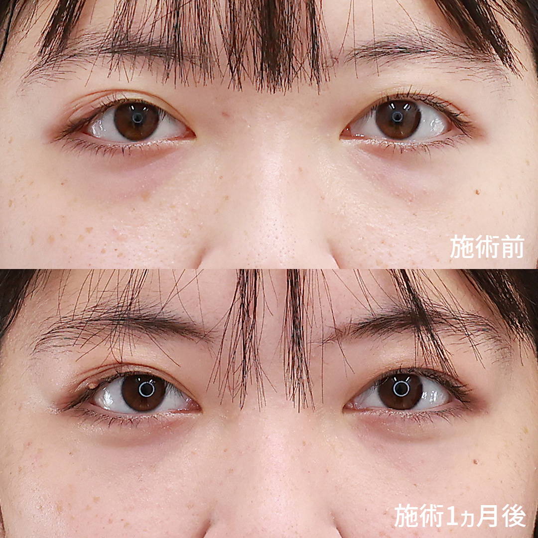 下眼瞼脱脂術(目の下のたるみ取り・目の下の脂肪ふくらみ取り)の症例写真 施術前後