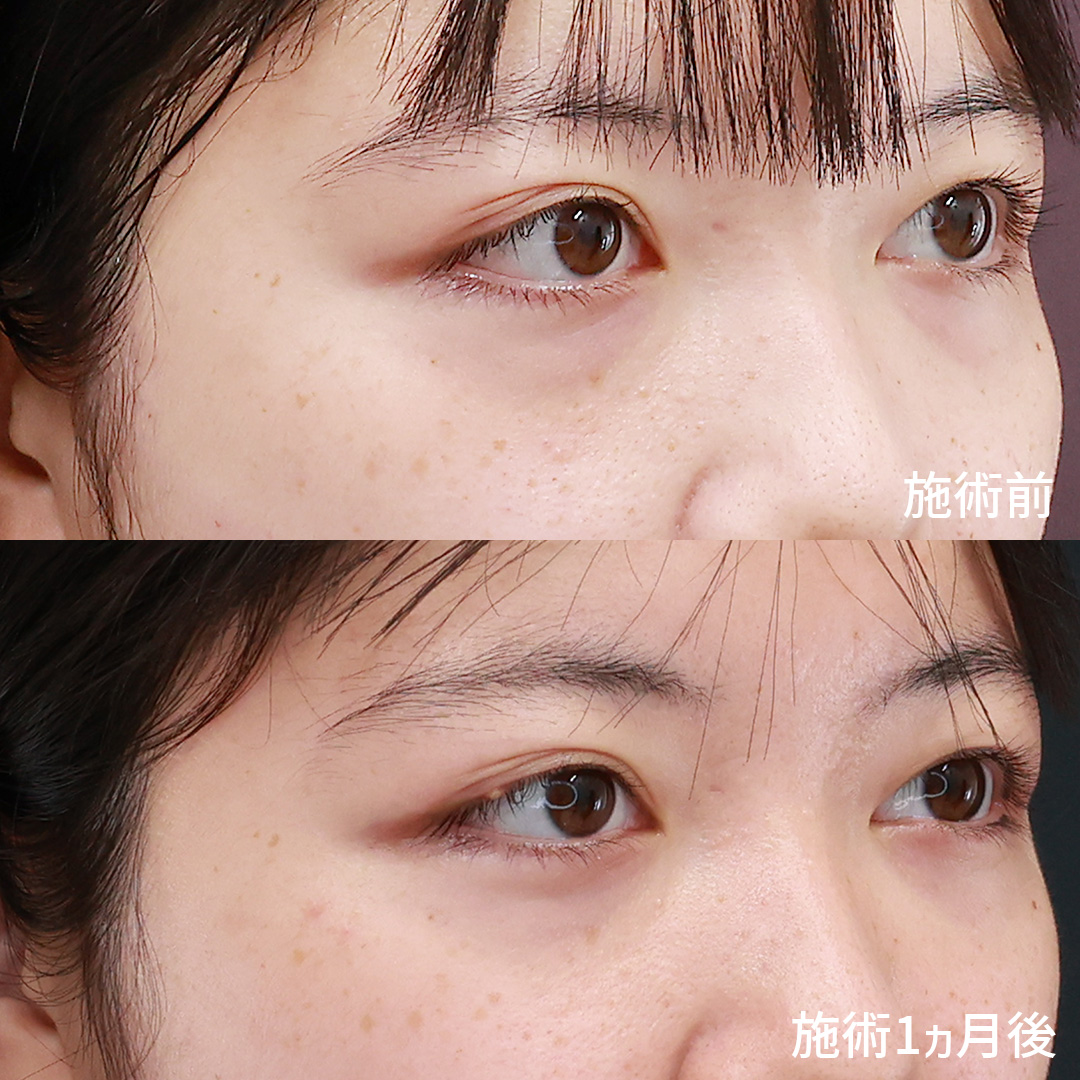 下眼瞼脱脂術(目の下のたるみ取り・目の下の脂肪ふくらみ取り)の症例写真 施術前後
