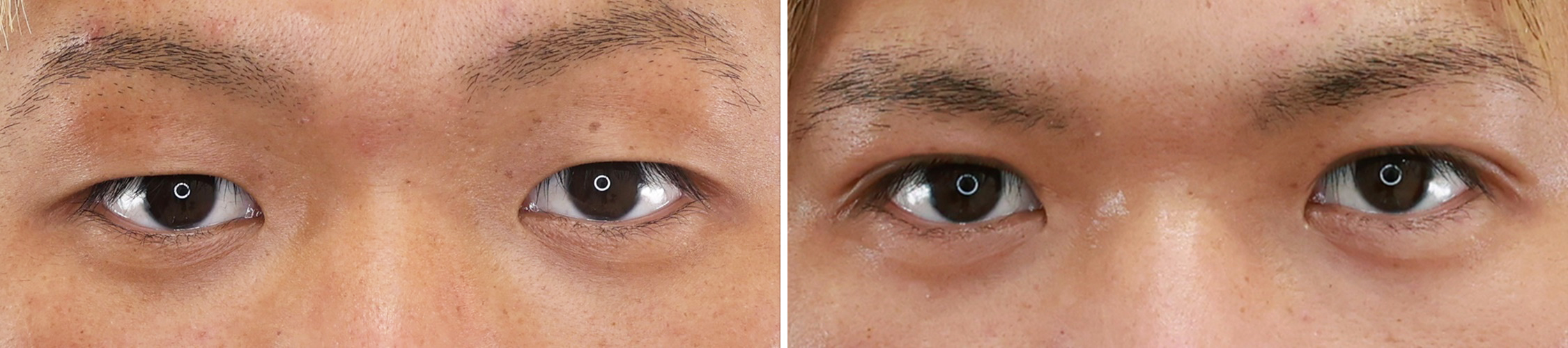 二重埋没法の症例写真 施術前後 1ヵ月