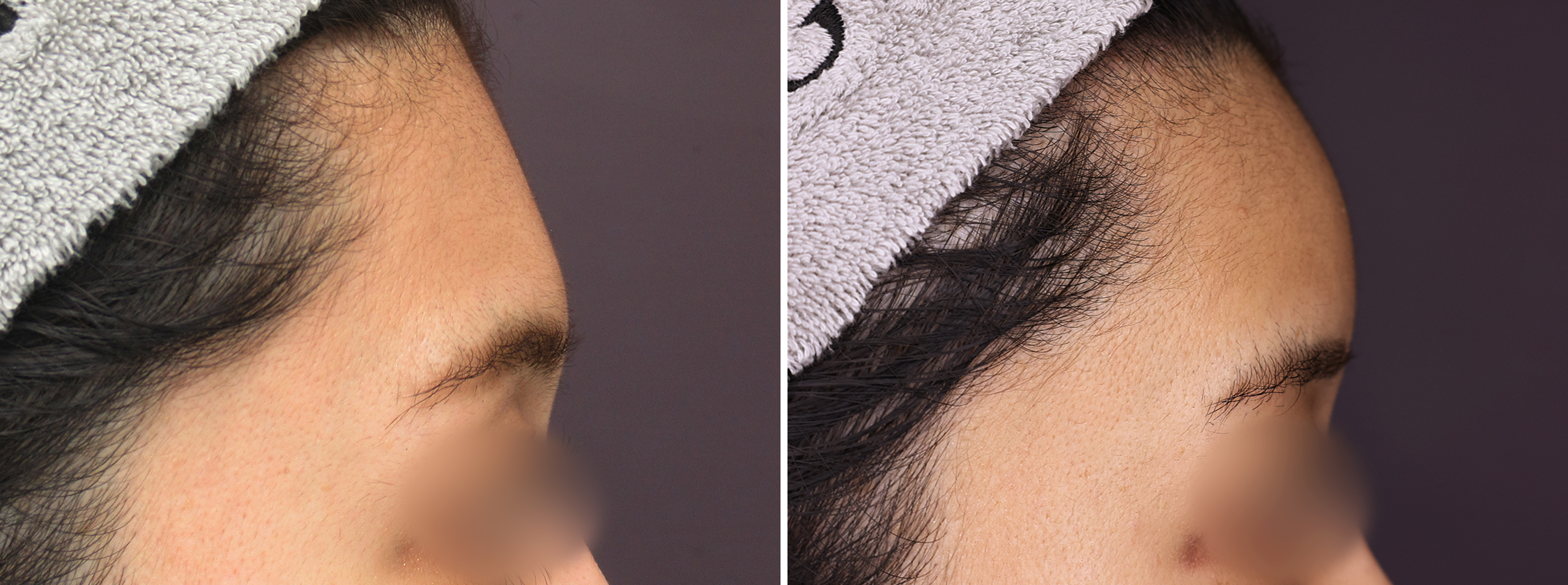 顔の脂肪注入(コンデンスリッチフェイス)/TAC式 ツヤ肌コラーゲンリフト®/ジョールファット除去の症例写真 施術前後 1ヶ月