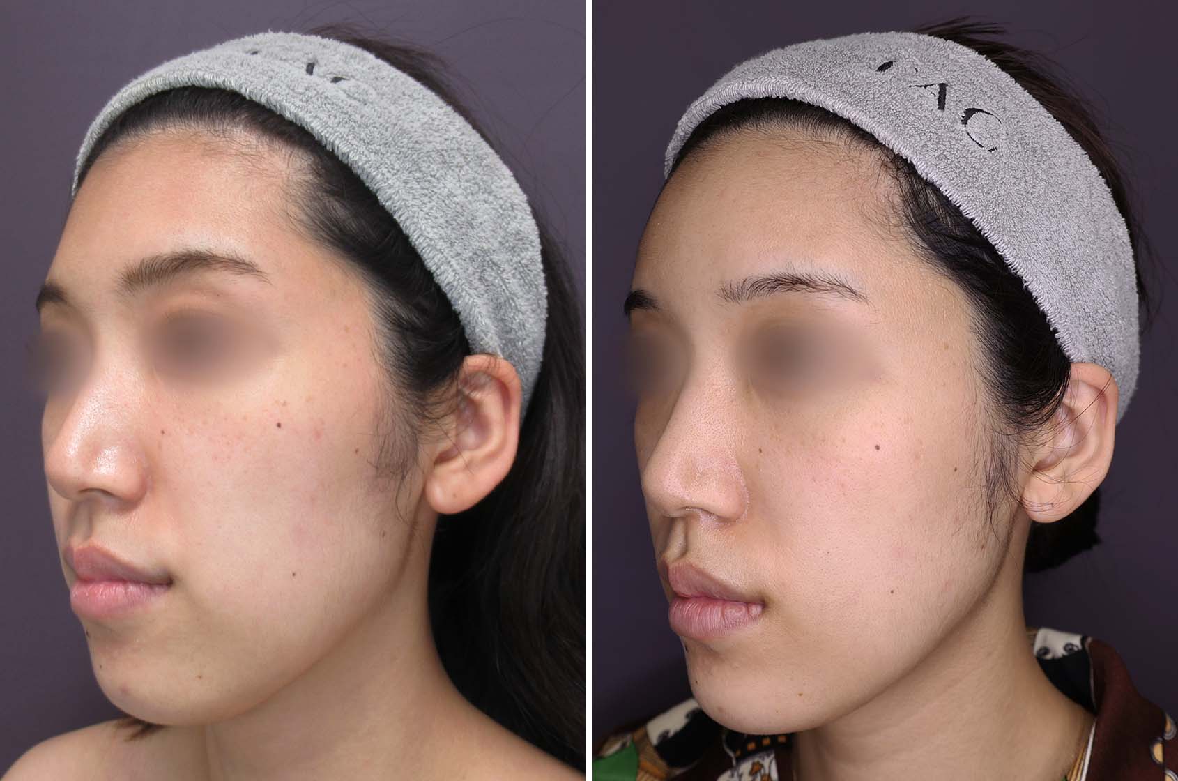 顔の脂肪注入(コンデンスリッチフェイス)/TAC式 ツヤ肌コラーゲンリフト®/ジョールファット除去の症例写真 施術前後 1ヶ月