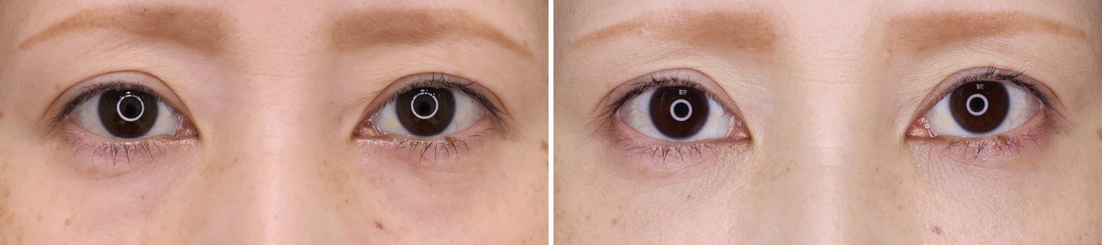 目の下の影は若見えの敵！クマ取りと脂肪注入で見た目年齢を巻き戻す