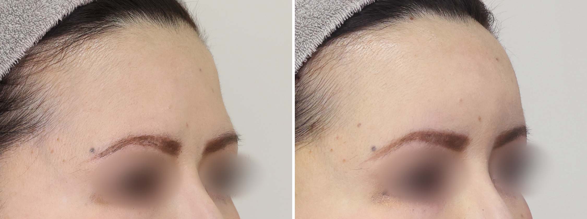 顔の脂肪注入(コンデンスリッチフェイス)の症例写真 施術前後 1週間