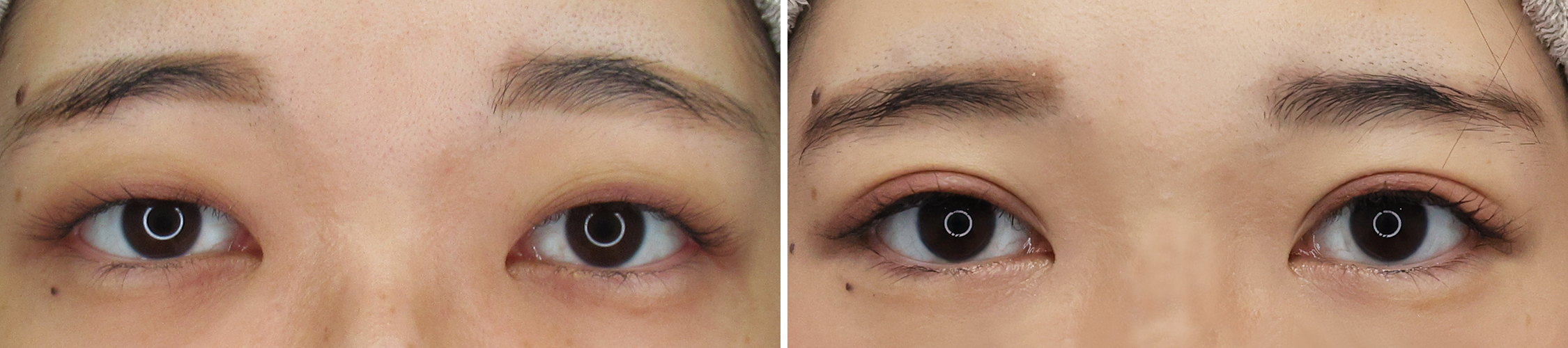 二重埋没法でイメージチェンジ！華やかな印象のお目元へ