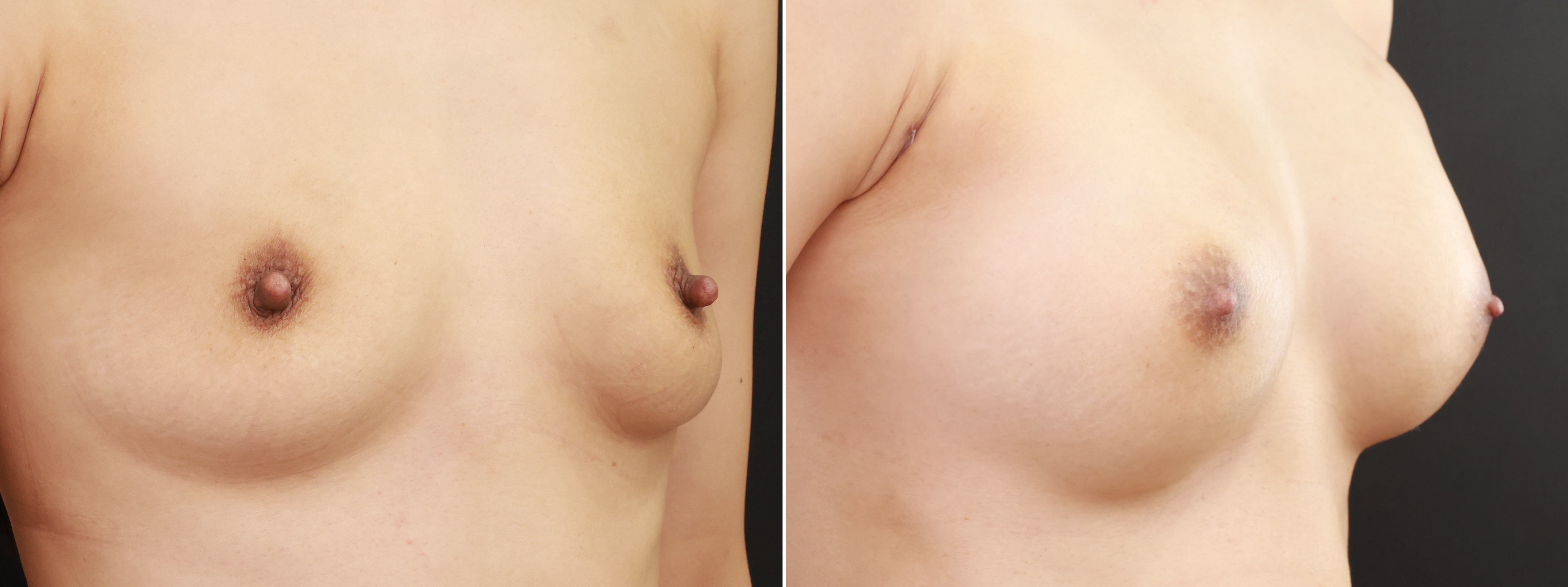 乳頭縮小術/ヒアルロン酸注入豊胸術(グラビアバスト)の症例写真 施術前後 1ヵ月
