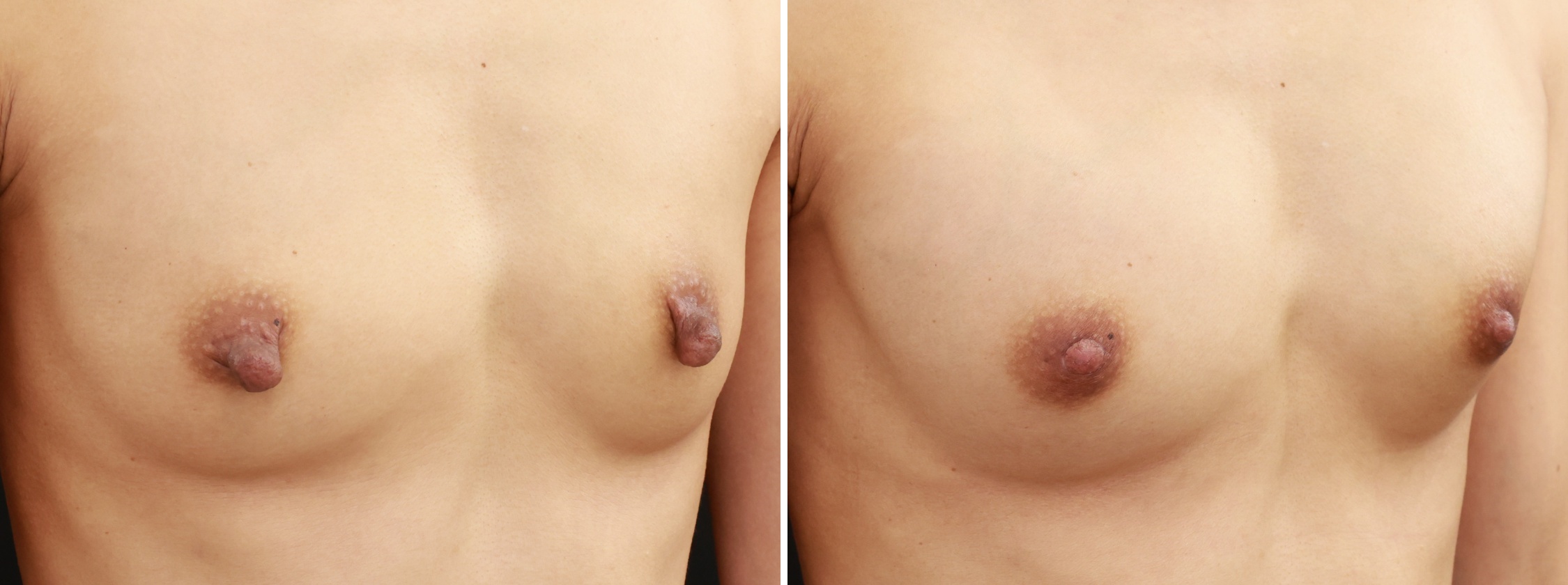 乳頭縮小術とヒアルロン酸豊胸術でハリのあるバストへ