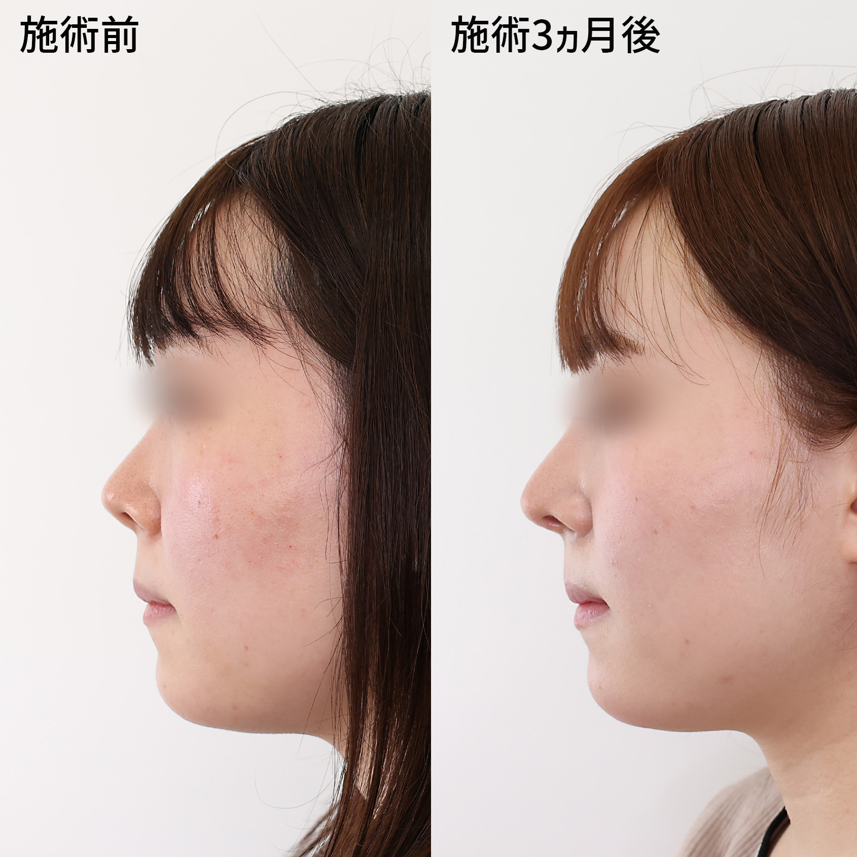 鼻中隔延長術/鼻尖形成・鼻尖縮小/鼻先軟骨移植の症例写真 施術前後 3ヵ月