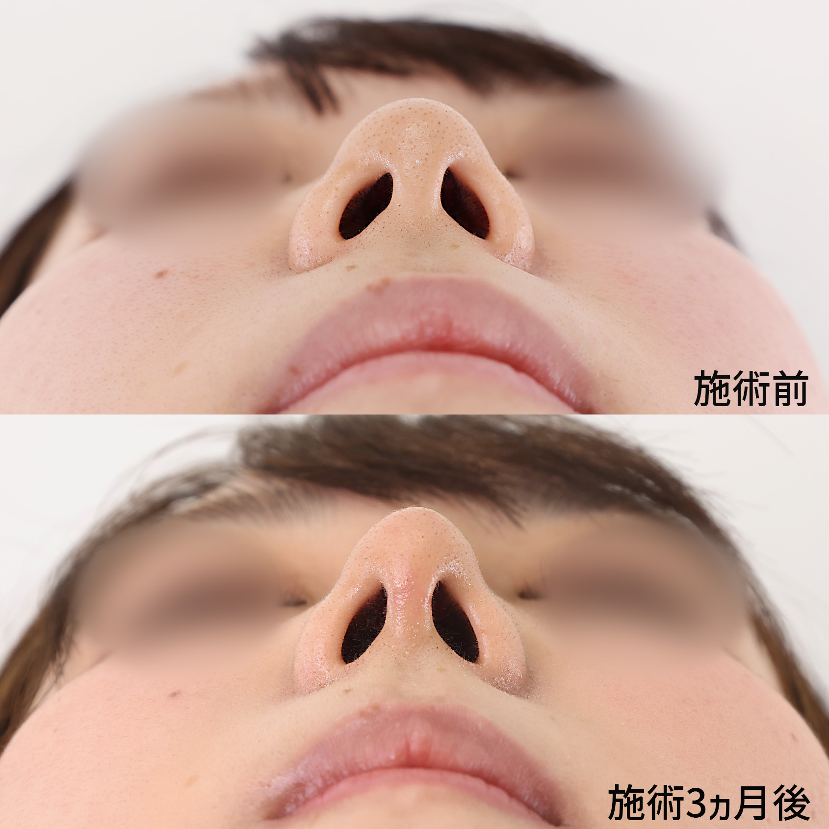 鼻中隔延長術/鼻尖形成・鼻尖縮小/鼻先軟骨移植の症例写真 施術前後 3ヵ月