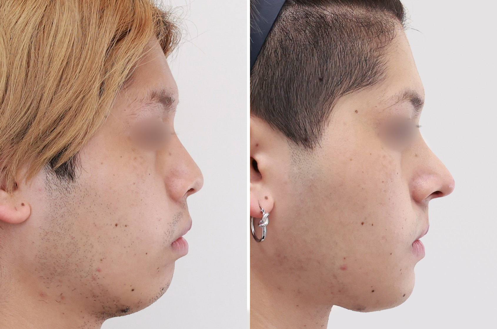 鼻尖形成 団子鼻 を改善してシャープな鼻先を形成 経過 ダウンタイム 値段 糸による切らない方法について Taクリニックグループ 美容整形 美容外科 全国展開中