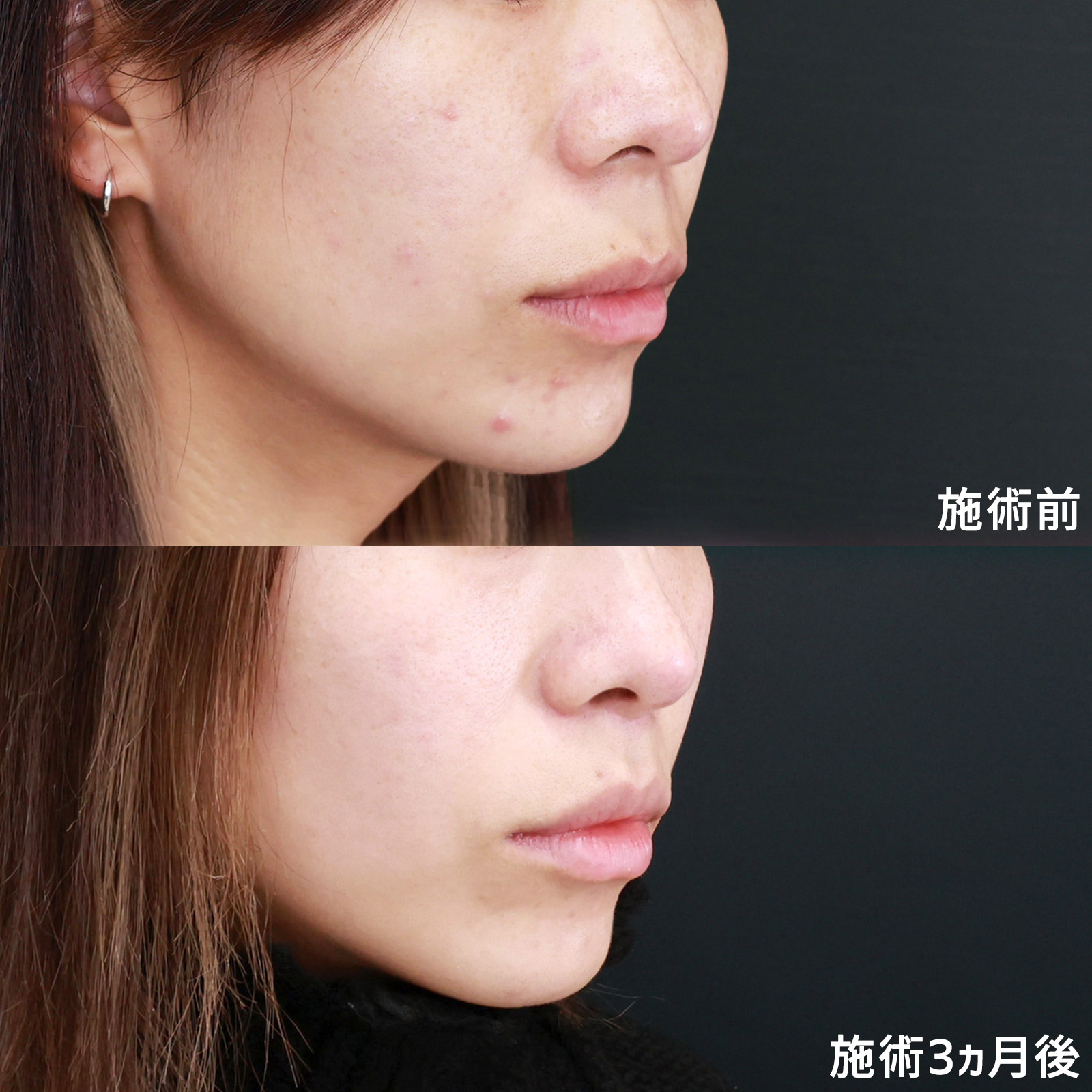 人中短縮術(リップリフト)・外側人中短縮術の症例写真 施術前後 