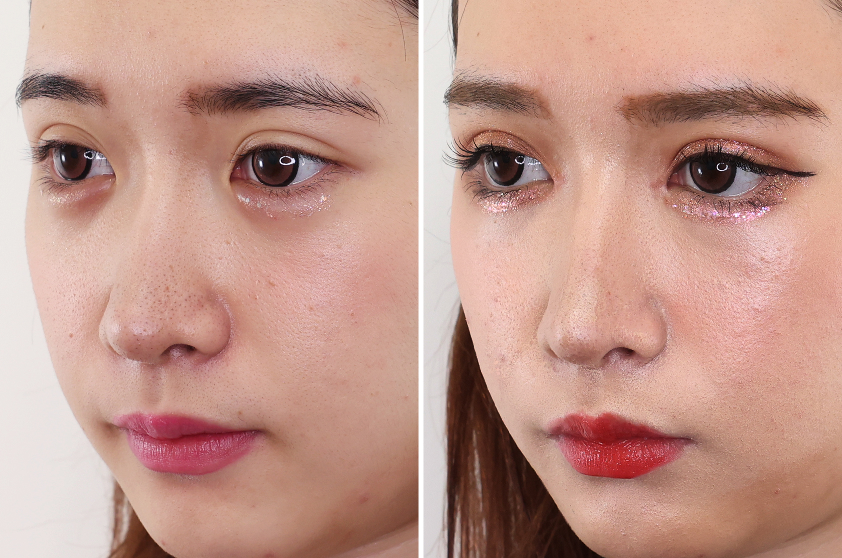 グラマラスライン(タレ目形成)/目頭切開術の症例写真 施術前後 1ヵ月