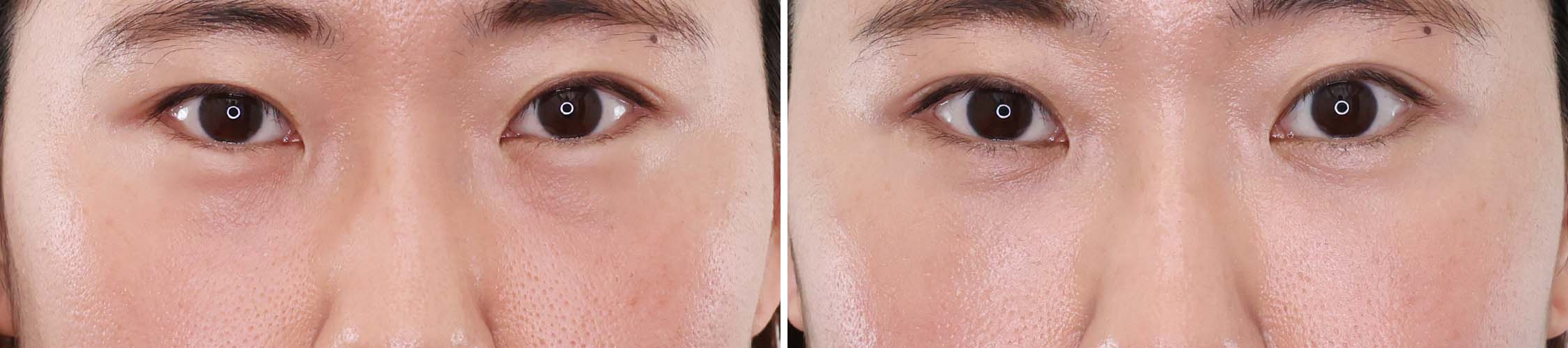 目の下の影がスッキリ！！　疲れて見える原因をクマ取り、脂肪注入で解決。