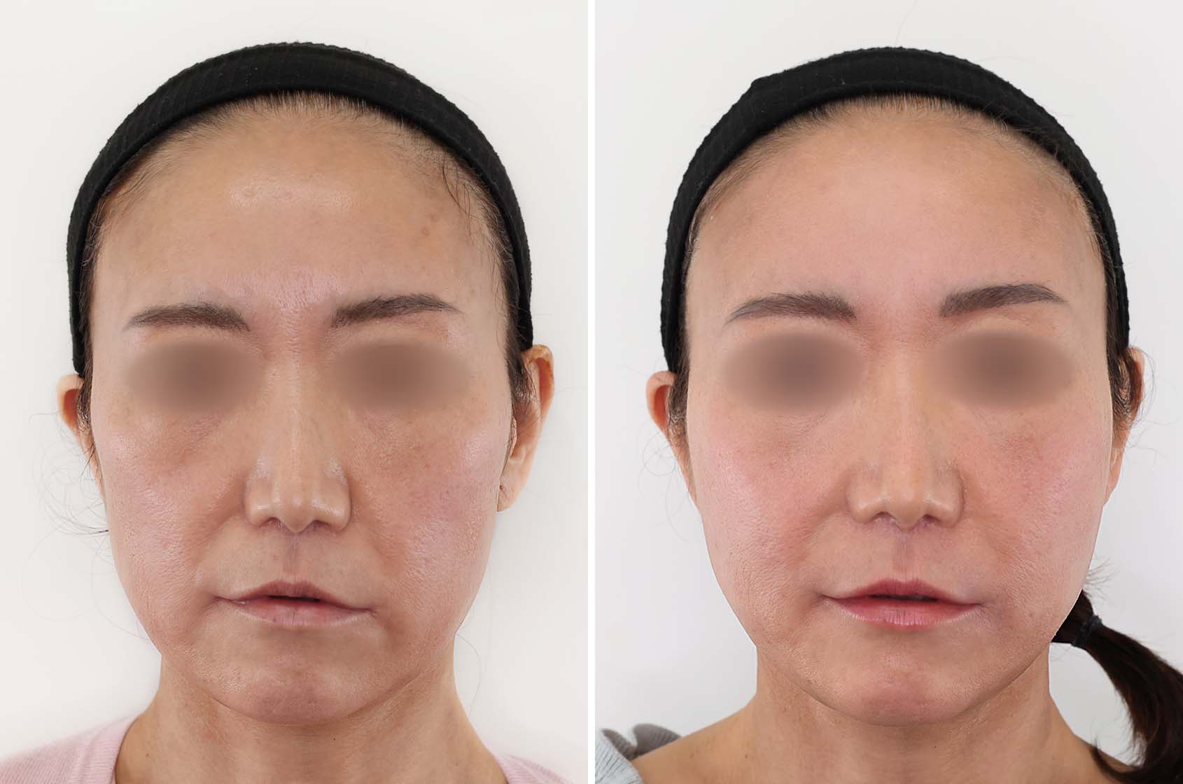 糸リフトで360度OK！ 自信が持てるフェイスラインの作り方。