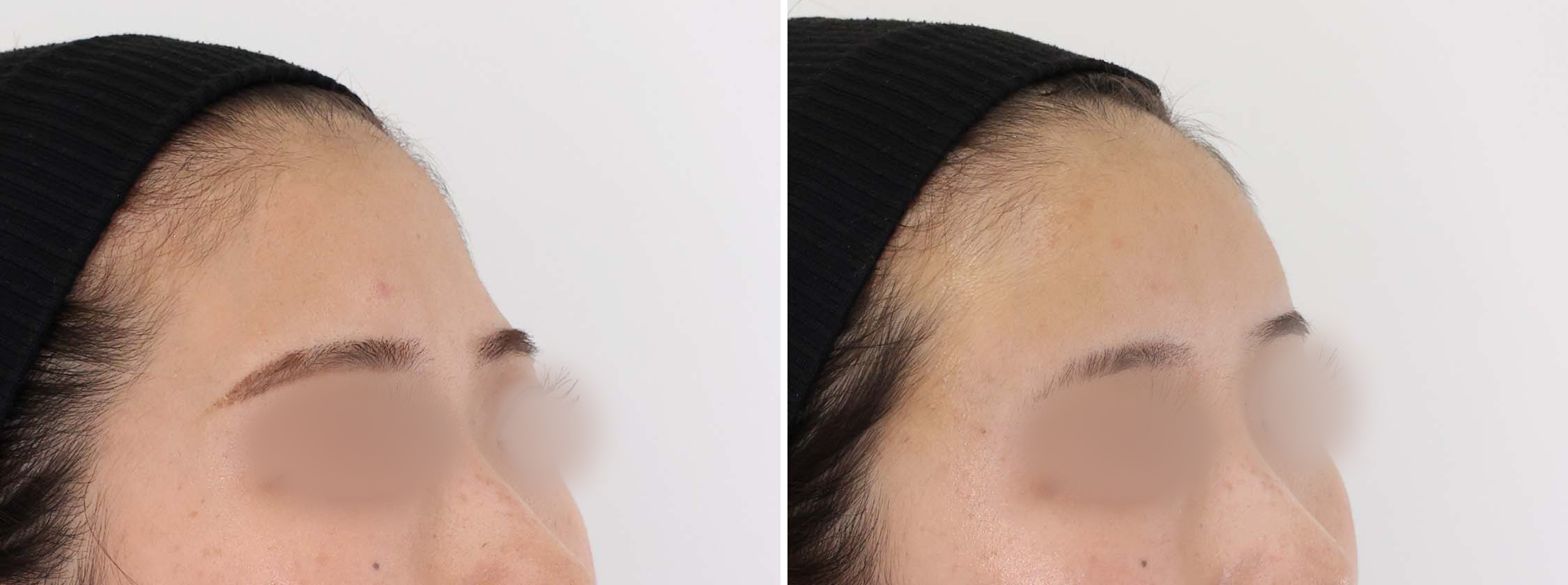 鏡を見るのが楽しくなる。丸くて可愛いオルチャンデコ！