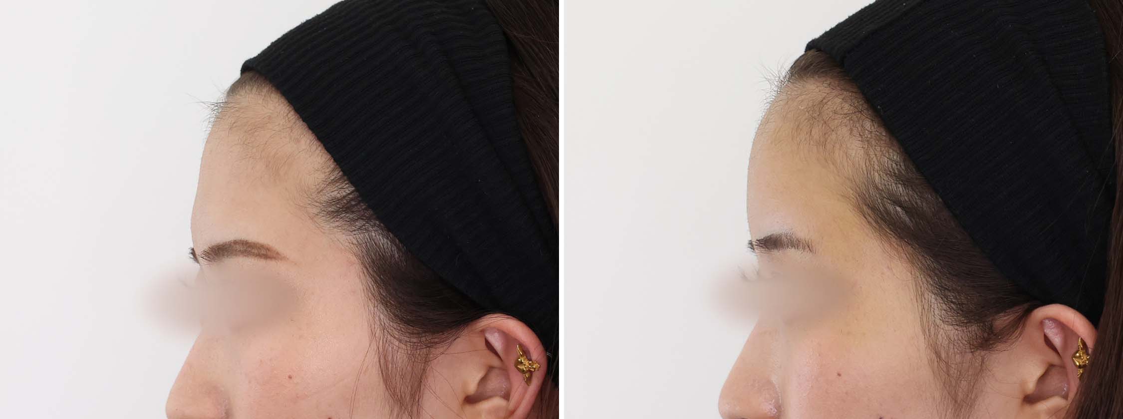 おでこの脂肪注入（オルチャンデコ形成）/顔の脂肪注入(コンデンスリッチフェイス)の症例写真 施術前後 1週間