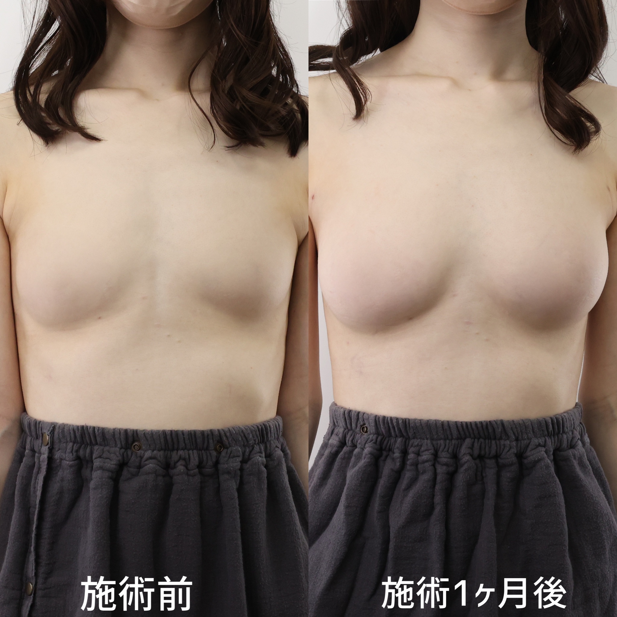 脂肪注入豊胸(コンデンスリッチ・ピュアグラフト・1day脂肪豊胸)の症例写真 施術前後 1ヵ月