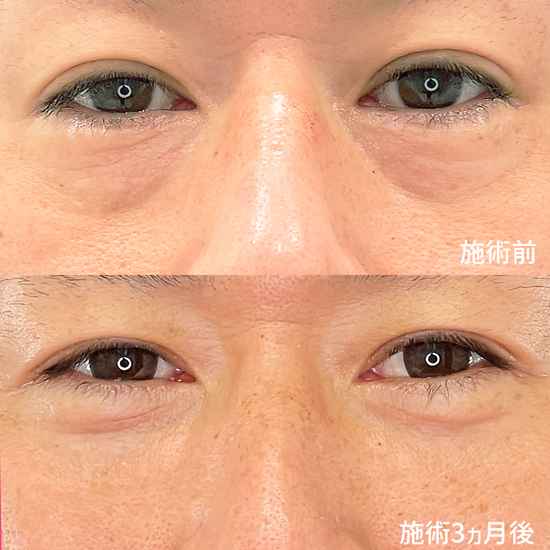下眼瞼脱脂術（目の下のたるみ取り・目の下の脂肪ふくらみ取り）/顔の脂肪注入(コンデンスリッチフェイス)の症例写真 施術前後 