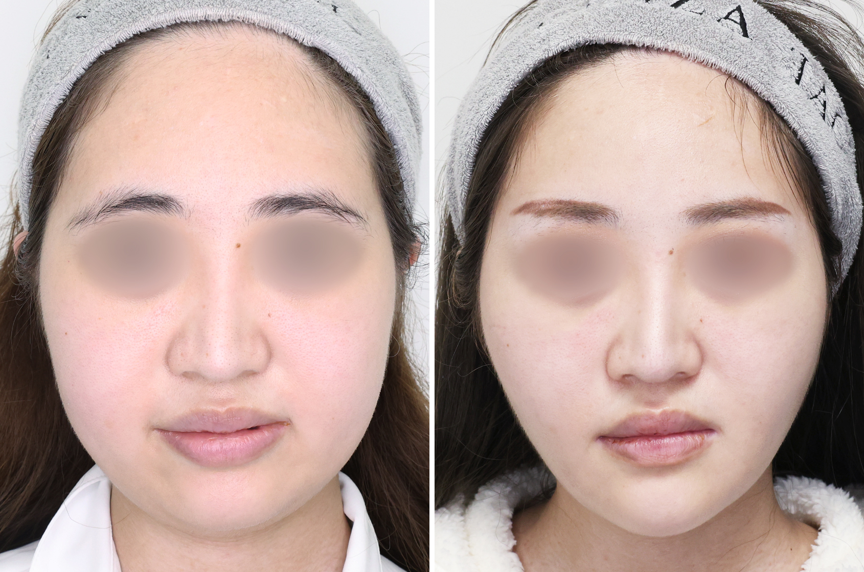 糸リフトやバッカルファット除去などの複合施術で別人級のすっきり小顔に