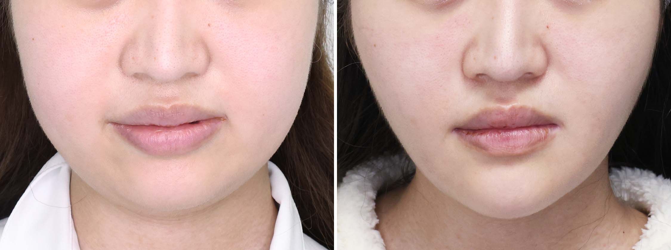 TAC式 ツヤ肌コラーゲンリフト®/バッカルファット除去/ジョールファット除去の症例写真 施術前後 2ヵ月