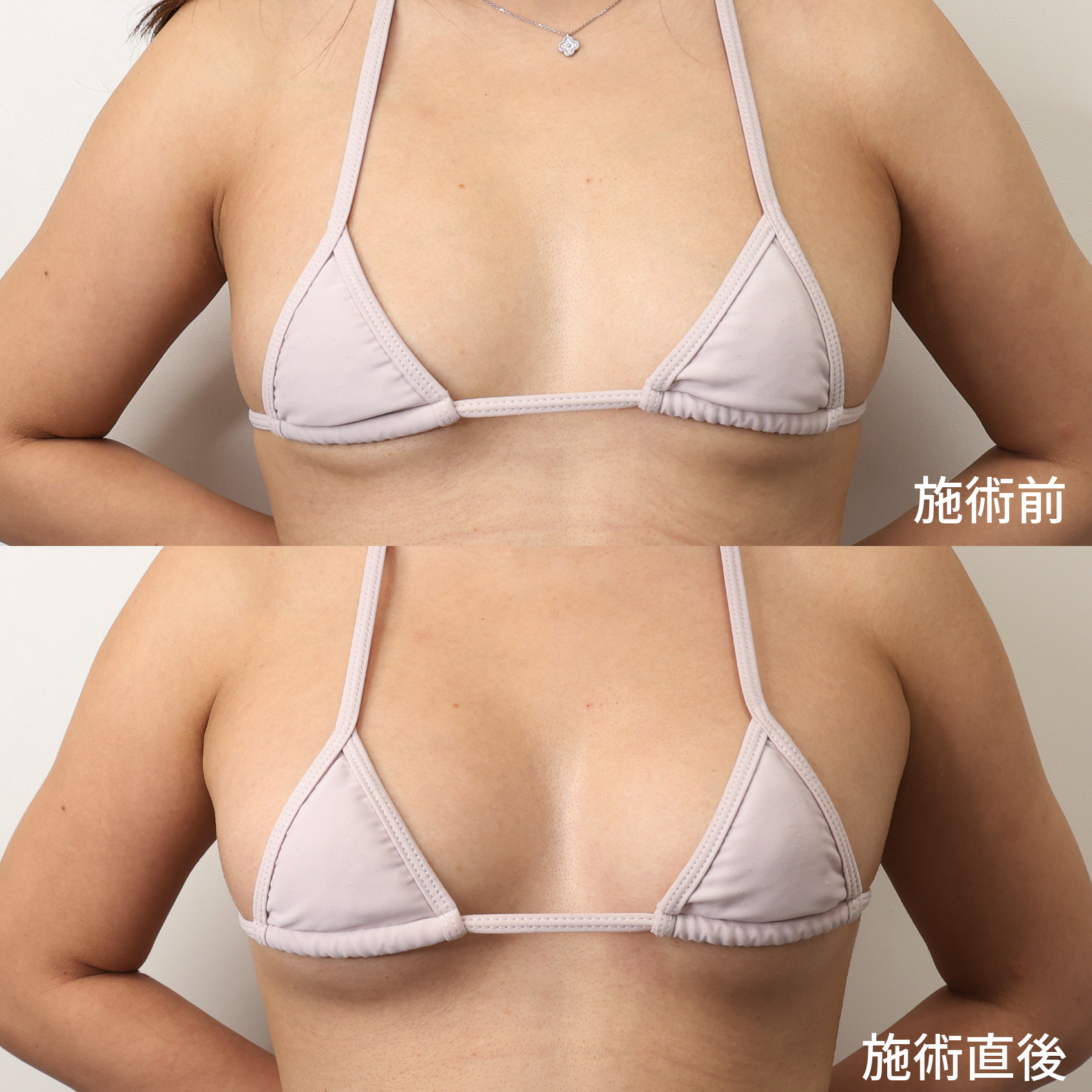 ヒアルロン酸注入豊胸術（グラビアバスト）の症例写真 施術前後 直後