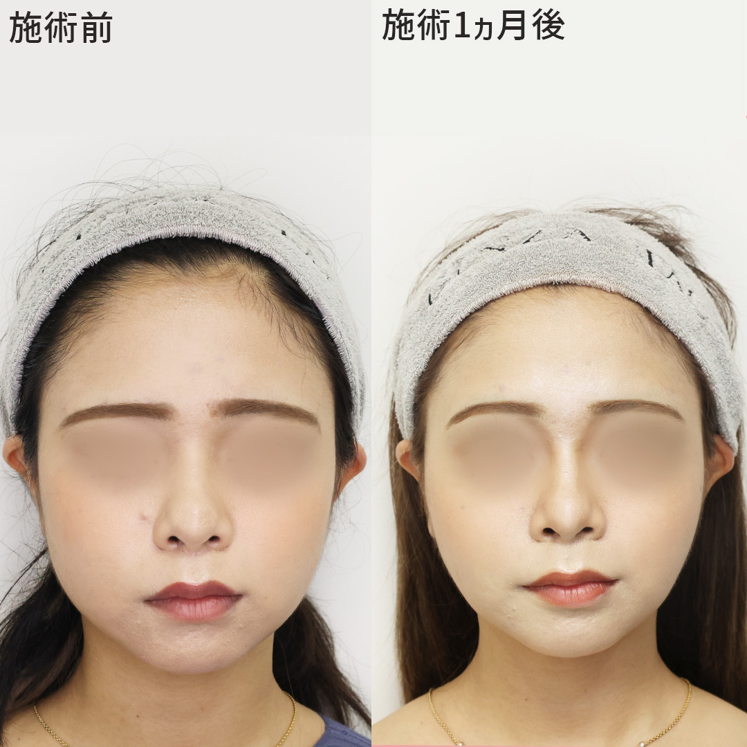 お顔の複合施術で自分史上一番の小顔へ