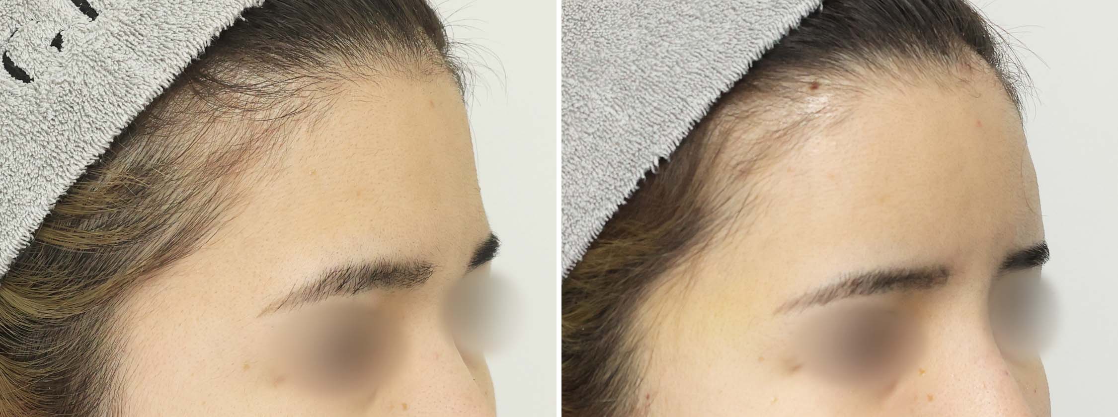 顔の脂肪注入(コンデンスリッチフェイス)の症例写真 施術前後 1週間