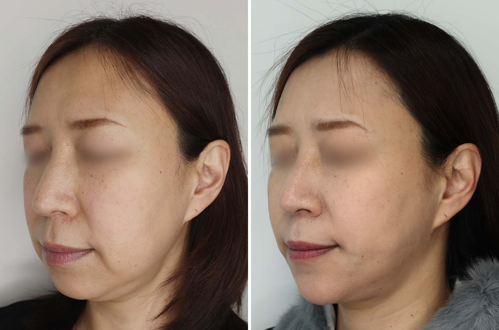 フェイスラインのもたつきを解消して別人級の輪郭整形！