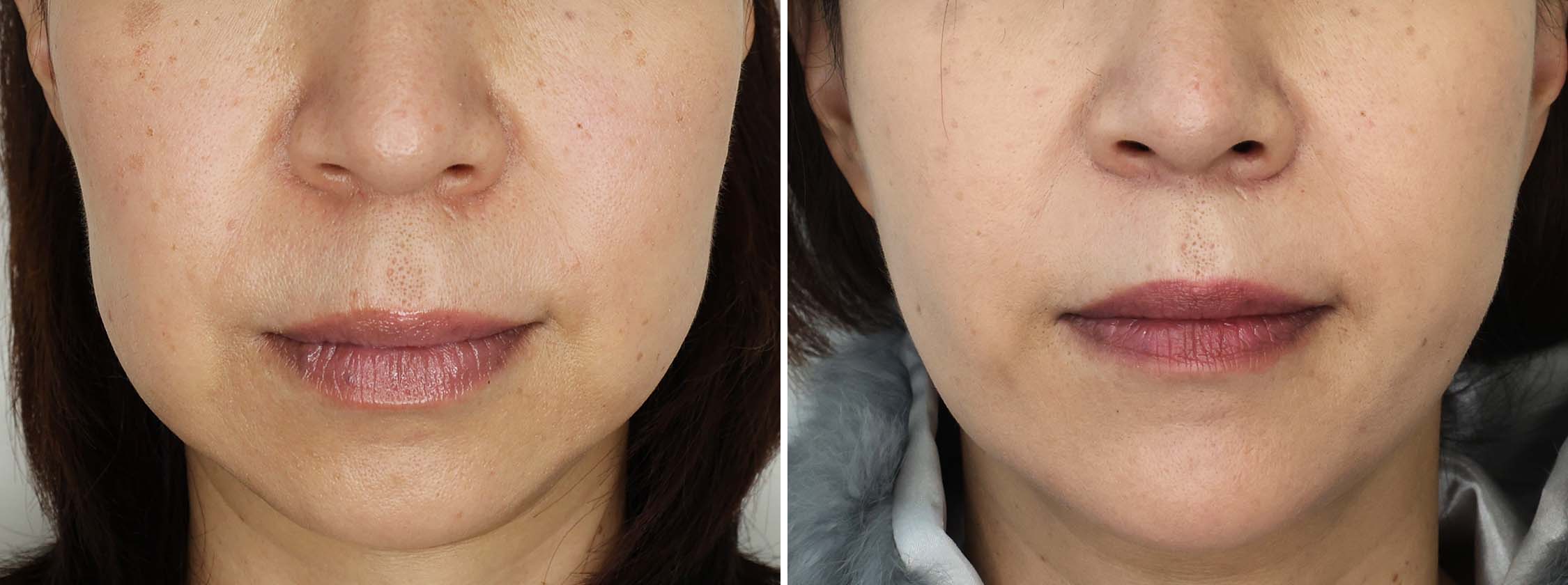 TAC式 ツヤ肌コラーゲンリフト®/ジョールファット除去/顎のヒアルロン酸注射の症例写真 施術前後 1ヵ月