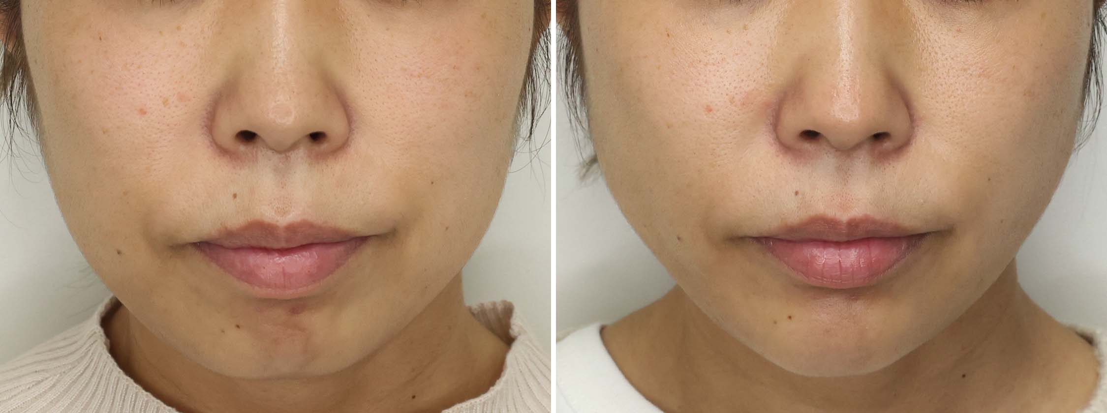 気になっていた頬のたるみをぐっと引き上げ