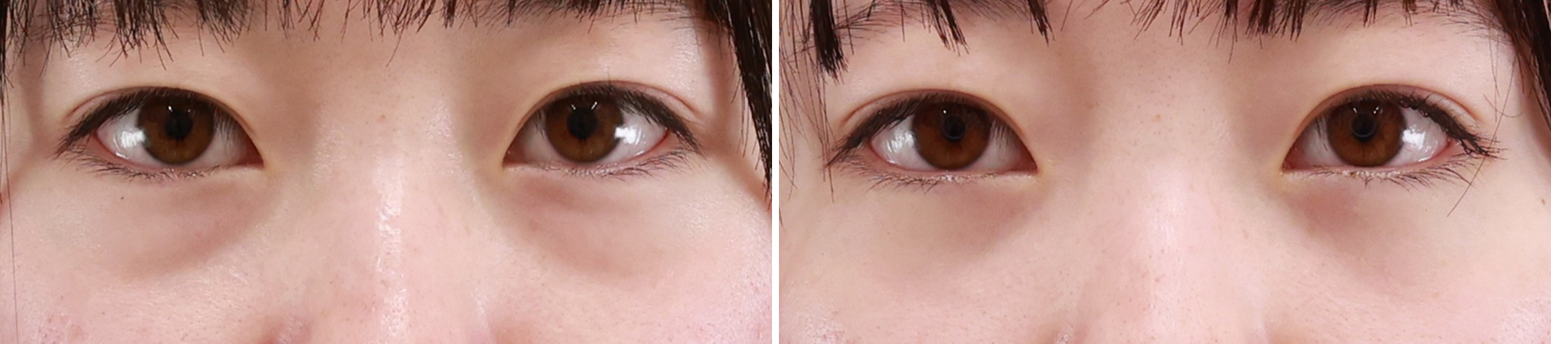 下眼瞼脱脂術（目の下のたるみ取り・目の下の脂肪ふくらみ取り）/顔の脂肪注入(コンデンスリッチフェイス)の症例写真 施術前後 2週間